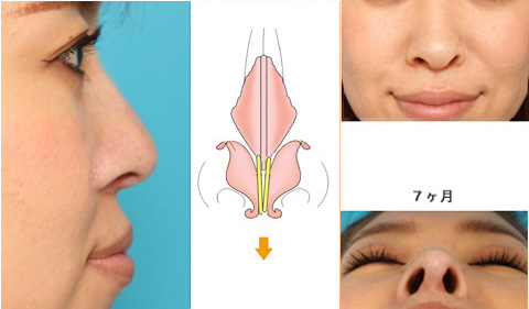 鼻尖や鼻柱の傾き・鼻孔の左右差