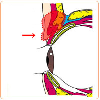厚ぼったいまぶたの治療
