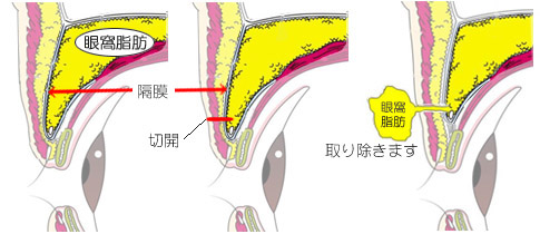 脱脂術に必要な皮膚の切開