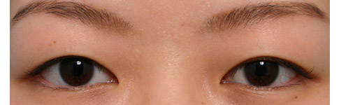 皮膚が余っているときの重瞼術