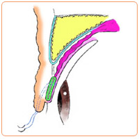 皮膚が余っているときの重瞼術