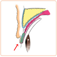 皮膚が余っているときの重瞼術