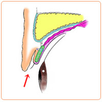 皮膚が余っているときの重瞼術