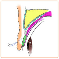 皮膚が余っているときの重瞼術