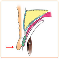 皮膚が余っているときの重瞼術