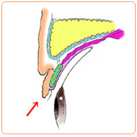 皮膚が余っているときの重瞼術