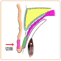 皮膚が余っているときの重瞼術