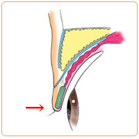 皮膚が余っているときの重瞼術