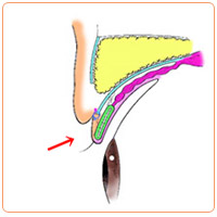 皮膚が余っているときの重瞼術