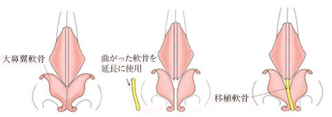 Ｓ字に曲がっていた移植軟骨