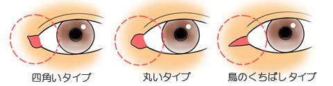 目頭切開:違和感