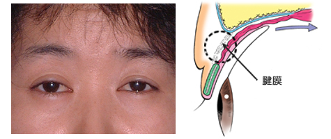 筋肉とまぶたの連結がゆるんだタイプ