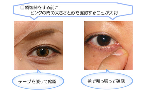 目頭切開をする前に確認すること