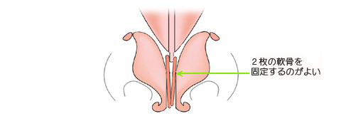 鼻中隔軟骨と保存軟骨を併せて２枚