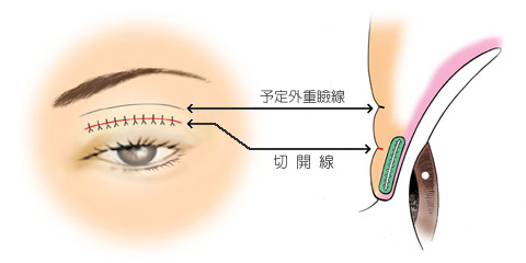 予定外重瞼線の治療