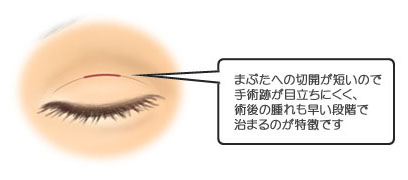 小切開