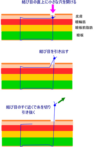 二重埋没糸抜去とは