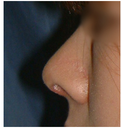 鼻背のラインに沿って延長した結果、鼻が大きくなる