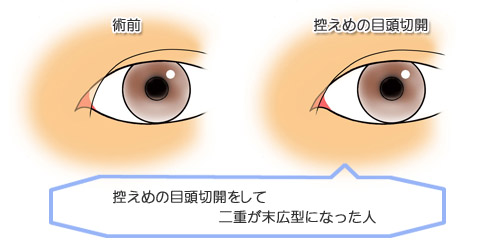 目頭切開:二重を広くする必要があります