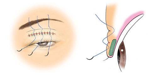 予定外重瞼線の治療