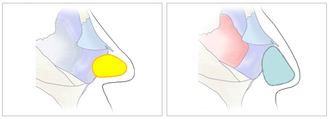 鼻中隔軟骨を使って再延長