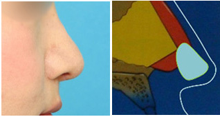 幅の広い板状の軟骨を使って、鼻先と鼻柱の両方を下へ伸ばす