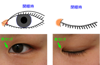 蒙古ひだがあると 平行型の二重にならないって本当 ヴェリテクリニック 公式 東京 名古屋 大阪 美容整形 美容外科