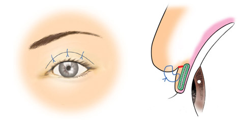 予定外重瞼線の治療