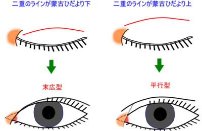 蒙古ひだと二重の関係