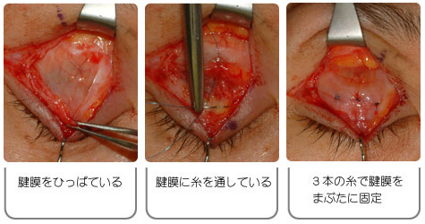 眼瞼下垂: 腱膜前転術の手術