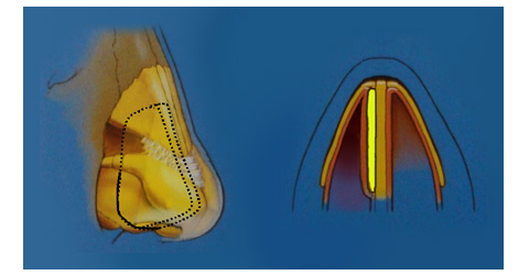 internal valve