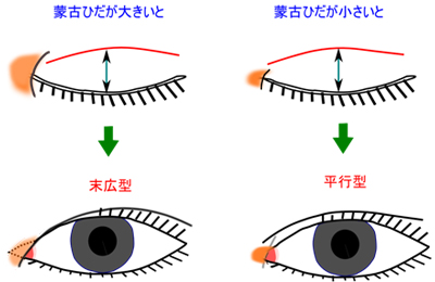 蒙古ひだと二重の関係