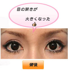 眼瞼下垂:目の開きが確実に大きく