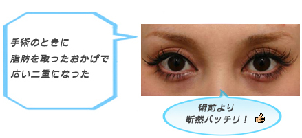 眼瞼下垂:アイメークと眼瞼下垂の手術の関係