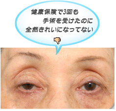 眼瞼下垂:健康保険がきく眼瞼下垂の手術