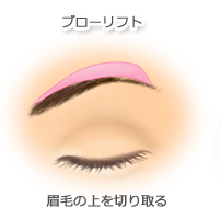 ボトックス器具の写真