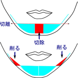 アゴの骨を小さくする手術