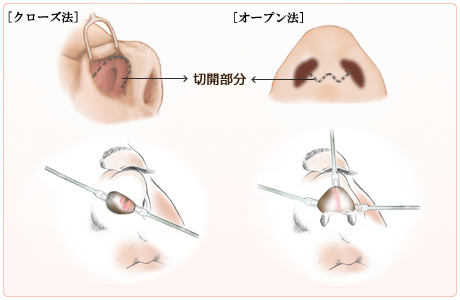 オープン法とクローズ法