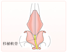 鼻の変形