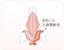 軟骨自身の変形