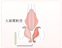 まっすぐな軟骨挿入