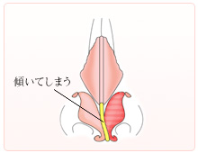 鼻の変形