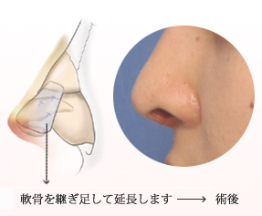 軟骨を継ぎ足して延長