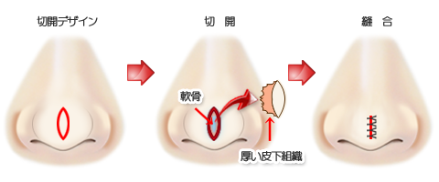 鼻尖縮小