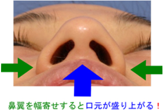 鼻翼縮小という手術について