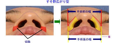 すそ野が広がったタイプ