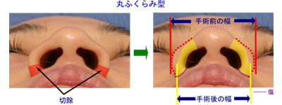 丸くふくらんだタイプ