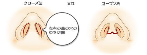 わし鼻