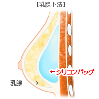 豊胸挿入位置