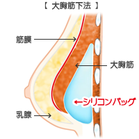 豊胸挿入位置